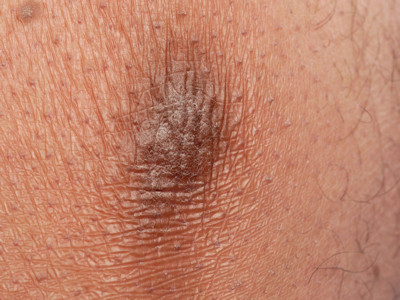 Lichen simplex chronicus