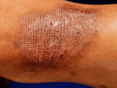 Lichen simplex chronicus