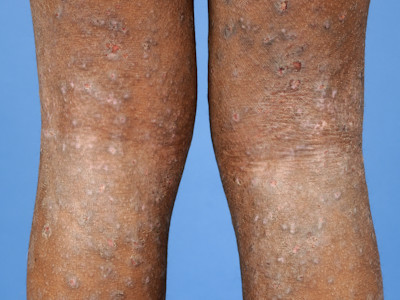 Lichenificatie bij atopisch eczeem