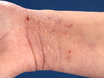 Lichenificatie bij atopisch eczeem