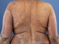 Lichenoïde toxicodermie