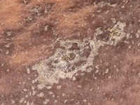 Lichenoïde toxicodermie