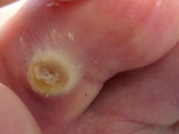 Removal of corns by the pedicure