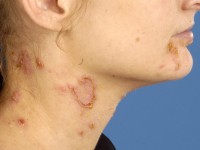 Linear IgA Dermatosis