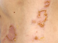 Linear IgA Dermatosis