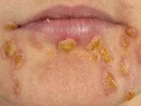 Linear IgA Dermatosis