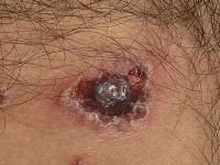 Lineaire IgA Dermatose