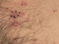 Lineaire IgA Dermatose