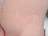 Lineaire epidermale naevus