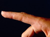 Lineaire epidermale naevus