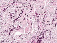 Lineaire focale elastosis