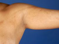 Lineaire sclerodermie