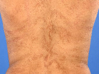 Linear and whorled nevoid hypermelanosis