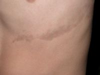 Lineaire atrophoderma van Moulin