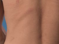 Lineaire atrophoderma van Moulin