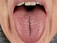 Lingua fissurata