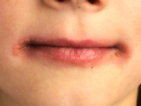 Lip licking dermatitis