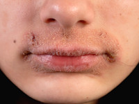 Lip licking dermatitis