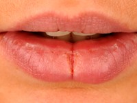 Median lip fissure