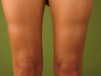 Lipoatrophia semicircularis