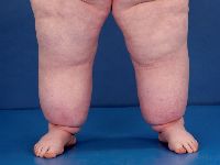 Lipo-oedeem, lipoedema, Allen-Hines