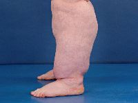 Lipo-oedeem, lipoedema, Allen-Hines