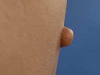 Lipofibroma (fibrolipoma)