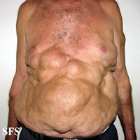 Pseuo-athletic appearance of Launois-Bensude syndroom, benign symmetric lipomatosis