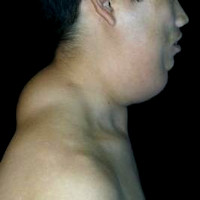 Pseuo-athletic appearance of Launois-Bensude syndroom, benign symmetric lipomatosis