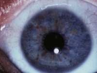 Lisch noduli bij neurofibromatosis