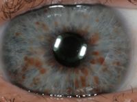 Lisch nodules in neurofibromatosis