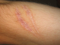 Hypertrofisch litteken