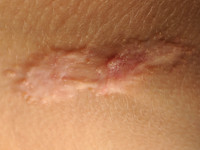 Hypertrofisch litteken