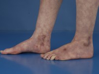 Livedoid vasculopathie