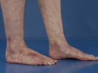 Livedoid vasculopathie