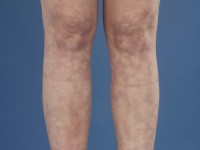 Livedoid vasculopathie