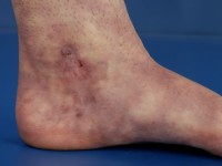 Livedoid vasculopathie