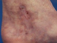 Livedoid vasculopathie