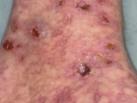 Livedo reticularis vasculitis met ulcera bij Factor V-Leiden