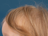 Loose anagen hair syndrome