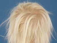 Loose anagen hair syndrome