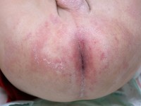 Diaper dermatitis