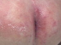 Diaper dermatitis