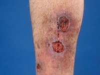 Ulcus cruris t.g.v. lupus anticoagulans