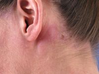 Reactieve lymfadenopathie