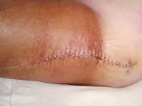 Stewart-Treves syndroom (maligne lymfangiosarcoom)