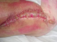 Stewart-Treves syndroom (maligne lymfangiosarcoom)