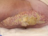 Stewart-Treves syndroom (maligne lymfangiosarcoom)