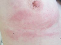 Lymfangitis carcinomatosa