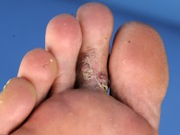 Lymfatische malformatie